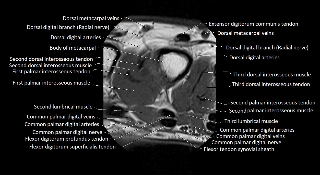 Finger anatomy axial cross sectional 3T image image 27.webp